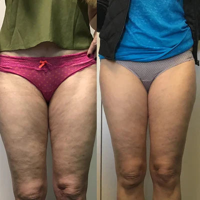 CelluLift™ Pro — Raffermissez votre peau sans effort